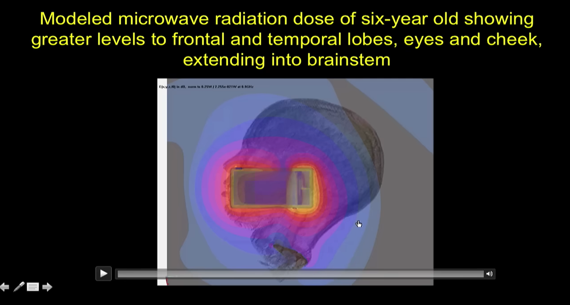 modeled microwave radiation dose of six-year old showing greater levels to frontal and temporal lobes, eyes and cheek, extending into brainstem
